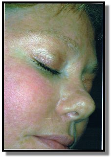 Mole before non-surgical removal