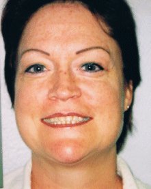 Skin texture after skin needling