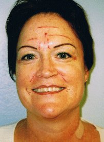 Skin texture before skin needling