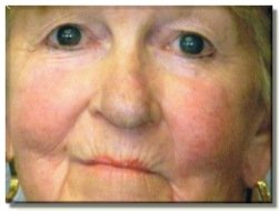 Spider vein after treatment