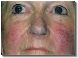 Spider vein before treatment